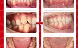 牙齿矫正照片前后对比