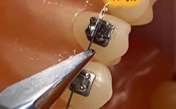 正畸靠切端贴托槽