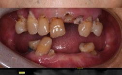 拜博口腔急拔急种牙可行吗？安全效果如何？