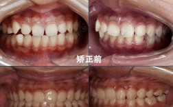 牙齿拥挤隐形矫正视频能看哪些矫正效果？