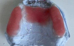 双曲舌簧矫治器制作方法