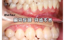 不用拔牙矫正牙齿，真的能不拔牙就变整齐吗？