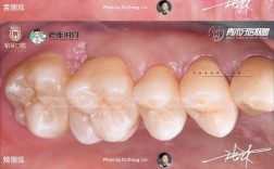 邻面去釉正畸效果如何？安全性与持久性怎么样？