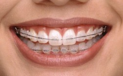 矫正牙齿选隐形牙套，效果和舒适度究竟如何？