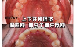 拔牙正畸牙缝合不上