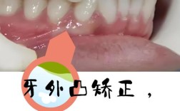 牙齿外凸矫正效果如何？过来人分享真实体验