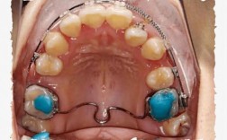 13岁正畸用口外弓有必要吗？有哪些注意事项？