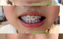 牙齿矫正摘掉牙套一般需要多长时间？