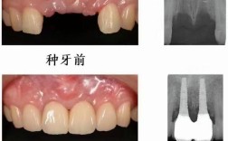 门牙三颗相连能植牙吗？