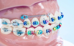 摇摆式矫治器正畸