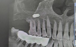 正畸治疗中上颌窦底是什么意思？