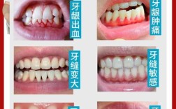 牙龈萎缩能植牙吗