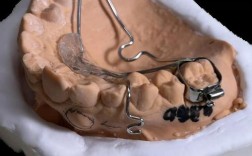 正畸横腭杆一般要戴多久？