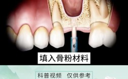 种牙骨是什么意思？牙齿种植前为何需要骨粉填充？作用与具体流程是怎样的？