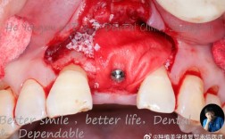 种牙前增骨有必要吗？为何不能直接种植？