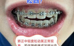 矫正完牙齿松动，是正常现象吗？该如何处理呢？