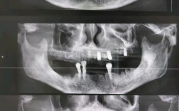 种牙后能做CT检查吗？术后多久可行？