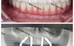 种牙一般选用什么材质的种植体？