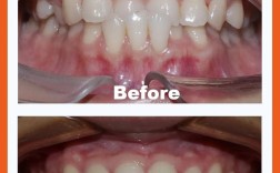 成人牙齿还能矫正吗