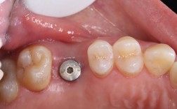 南京种牙修复怎么选？效果与价格靠谱吗？