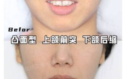 正畸会改变下巴