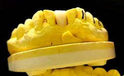 种牙后做的马里兰桥