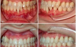 矫正牙齿后牙龈萎缩，是什么原因导致的？该如何正确应对与预防？