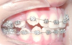 普通托槽矫正适合哪些牙齿情况？效果能维持多久？