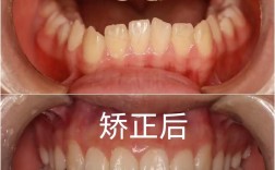 牙齿正畸之后的图