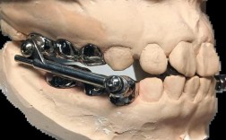 牙齿矫正器哪种最好？效果、舒适度、价格如何权衡？