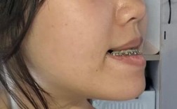 正畸牙齿下巴会歪