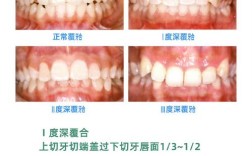 正畸根唇向转矩的风险