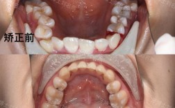 正畸中咬合问题频发？如何科学应对与调整？