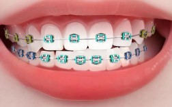 矫正牙齿用什么牙套好？不同牙套怎么选更合适？