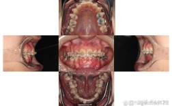 rw正畸失败案例