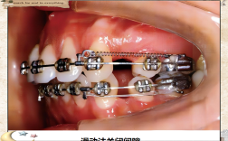 正畸关间隙弓形缩窄