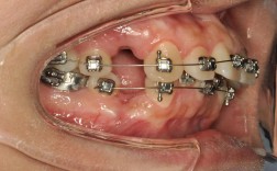 正畸上牙的带环型号