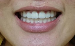 正畸后门牙中间出现牙缝，是矫正失败还是反弹？需要重新矫正吗？