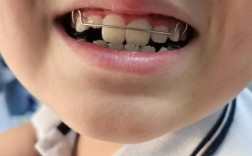 正畸矫正小孩子