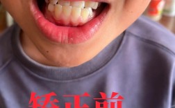 天包地牙齿矫正难度大吗？效果理想吗？需注意什么？