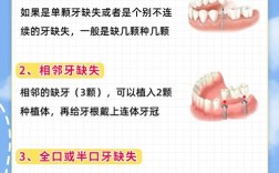 种一颗牙要多久