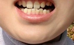 正畸期间牙缝变大