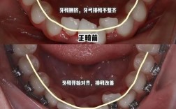 正畸过程中露龈笑