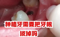 牙根拔掉后还能成功种牙吗？需要等待多久？有哪些注意事项和长期成功率？