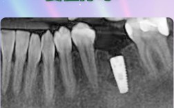 牙槽骨不足必须植骨吗？手术效果如何？