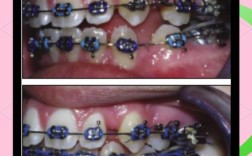 矫正牙齿上弹簧，究竟有何作用？