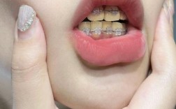 矫正牙齿为何会导致牙齿变黄？原因是什么？如何有效预防？