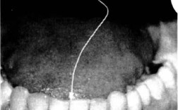 颞下颌关节弹响正畸