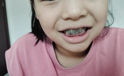 牙齿矫正3个月，矫正效果和变化如何？