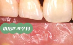 牙周骨手术后正畸治疗的最佳时机及效果如何把握？